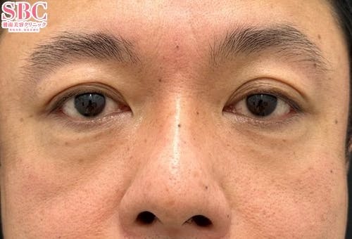 【男性・目元】ナチュラル脂肪注射コンデンスリッチ・目の下の切らないクマ・たるみ（ふくらみ）取り_after