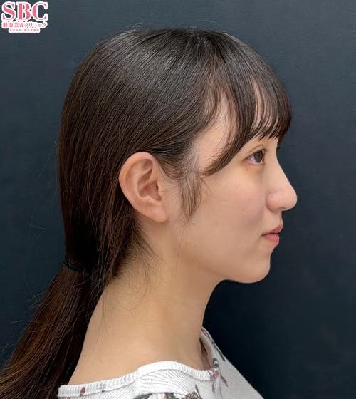 【20代女性・顔・顎下】Aquicell(アキーセル)脂肪吸引・根こそぎVASER脂肪吸引・エンブレイスRF_after