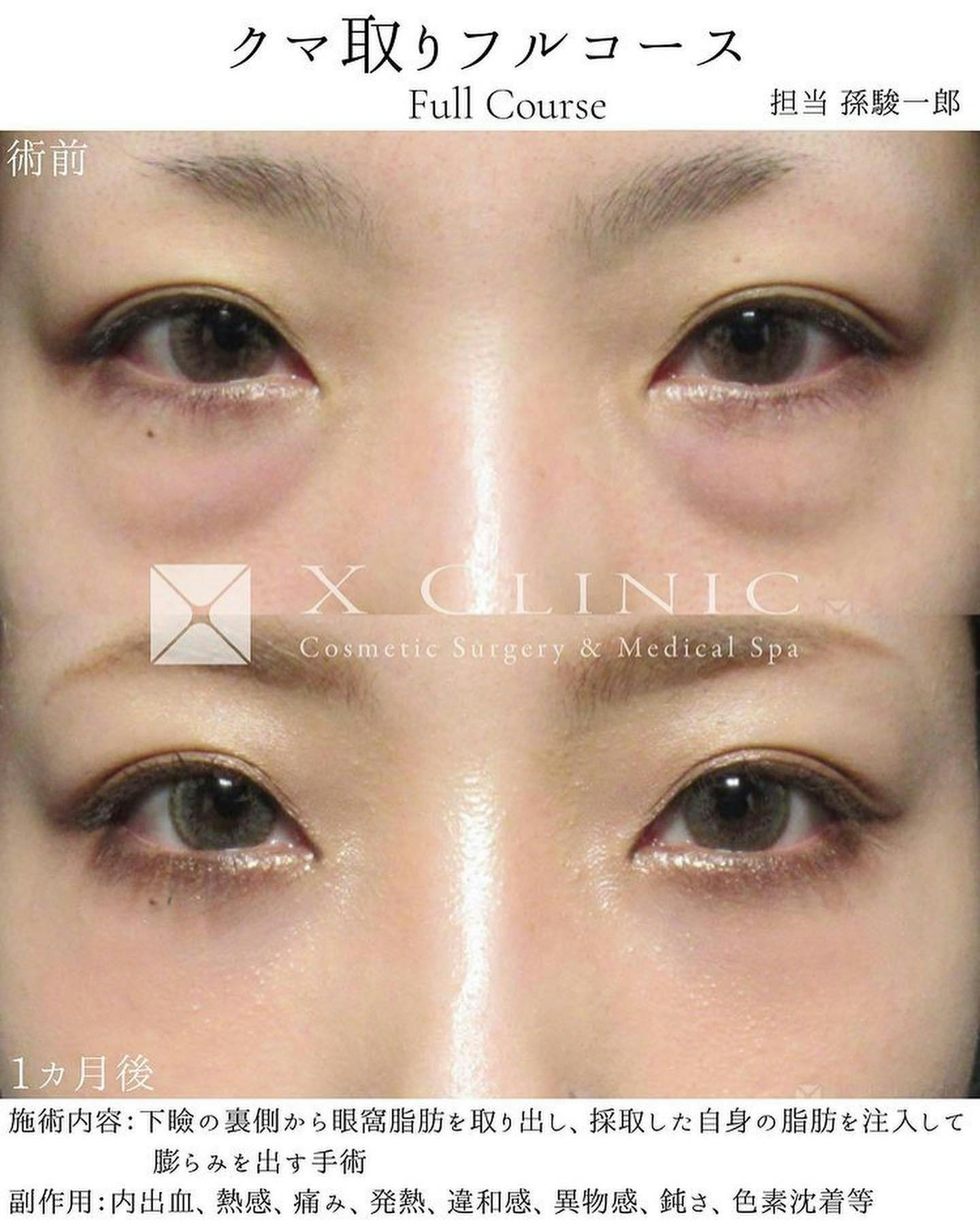 【女性・目元】クマ取りフルコース_before_aftar