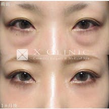 【女性・目元】クマ取りフルコース_before_aftar