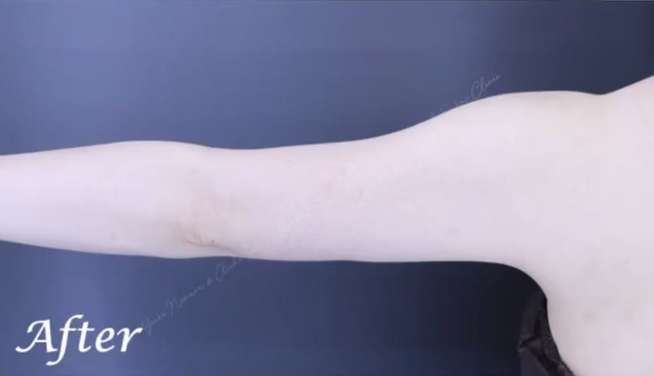 あいち栄クリニックで脂肪吸引(二の腕、肩)を受けたsakiさんの写真