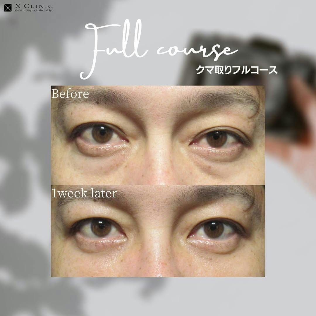 【クマ】クマ取りフルコース_before_aftar