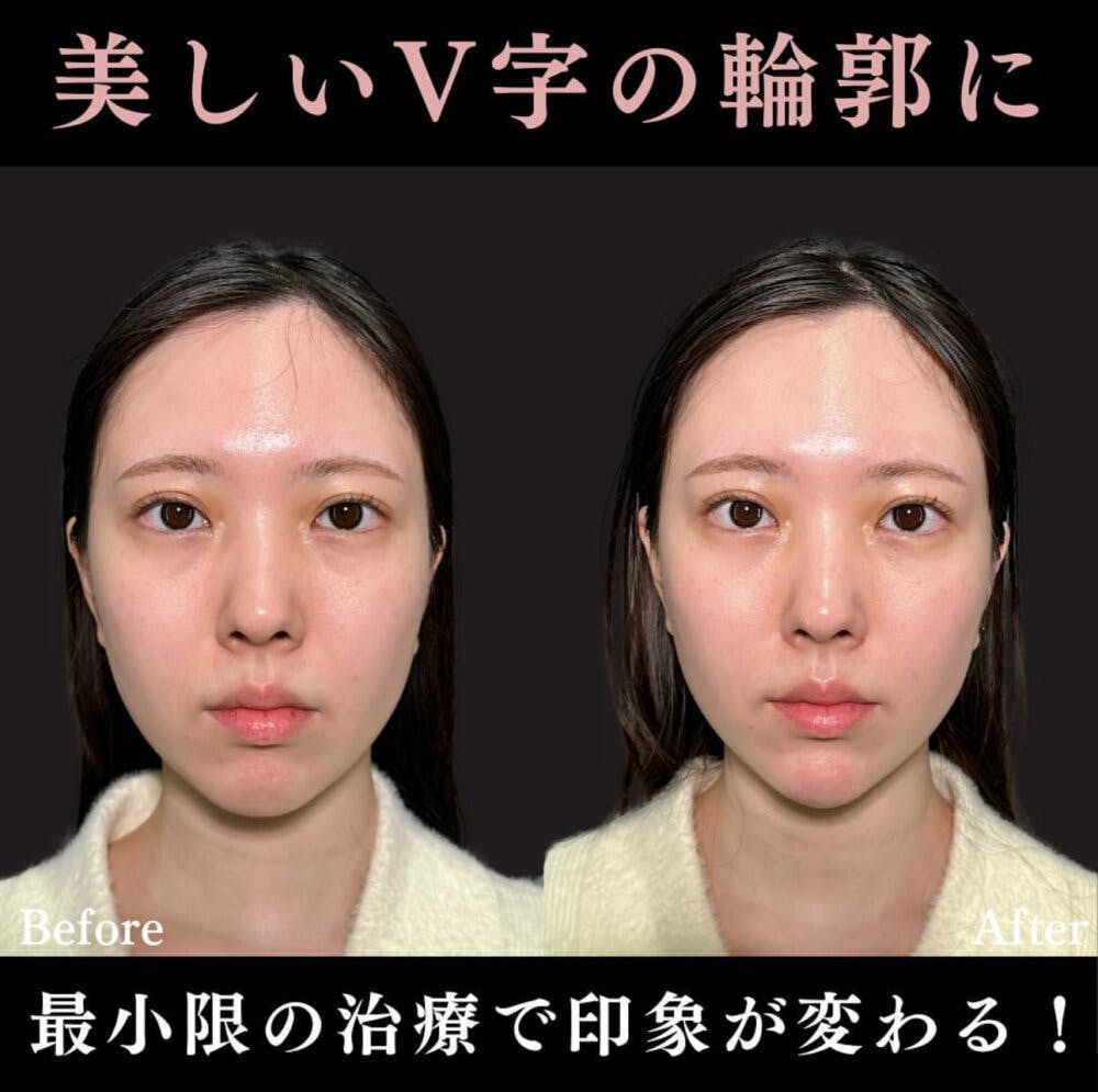 【20代女性・顎】あごのヒアルロン酸注射_before_aftar