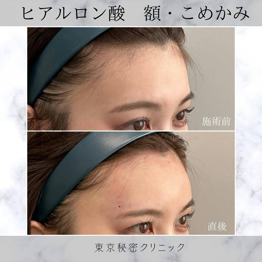 【女性・凹み】ヒアルロン酸（額・こめかみ）_before_aftar