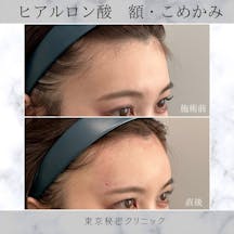 【女性・凹み】ヒアルロン酸(額・こめかみ)_before_aftar