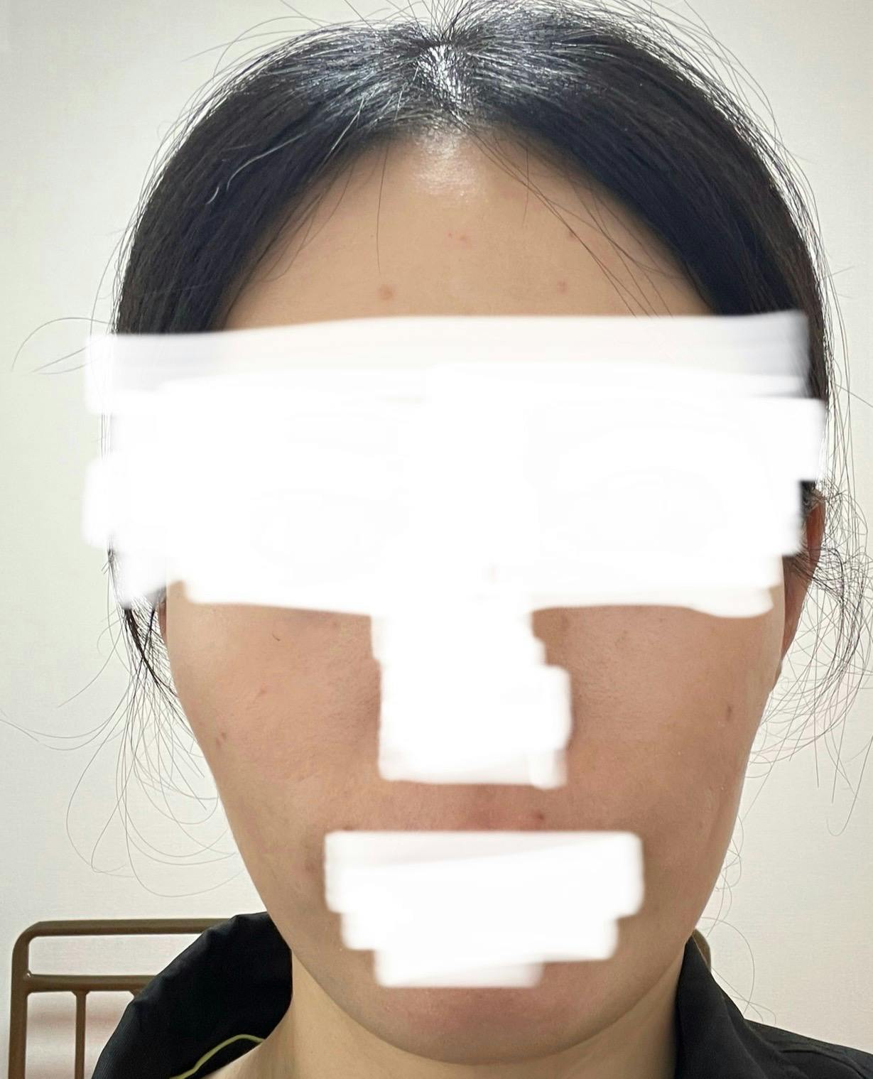 ベンスクリニック新宿でを受けたminさんの写真