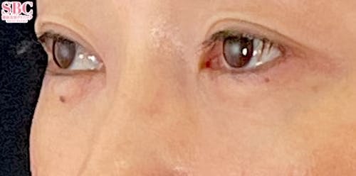 【40代女性・目元】_目の下の切らないクマ・たるみ（ふくらみ）取り、ナチュラル脂肪注射コンデンスリッチ_after