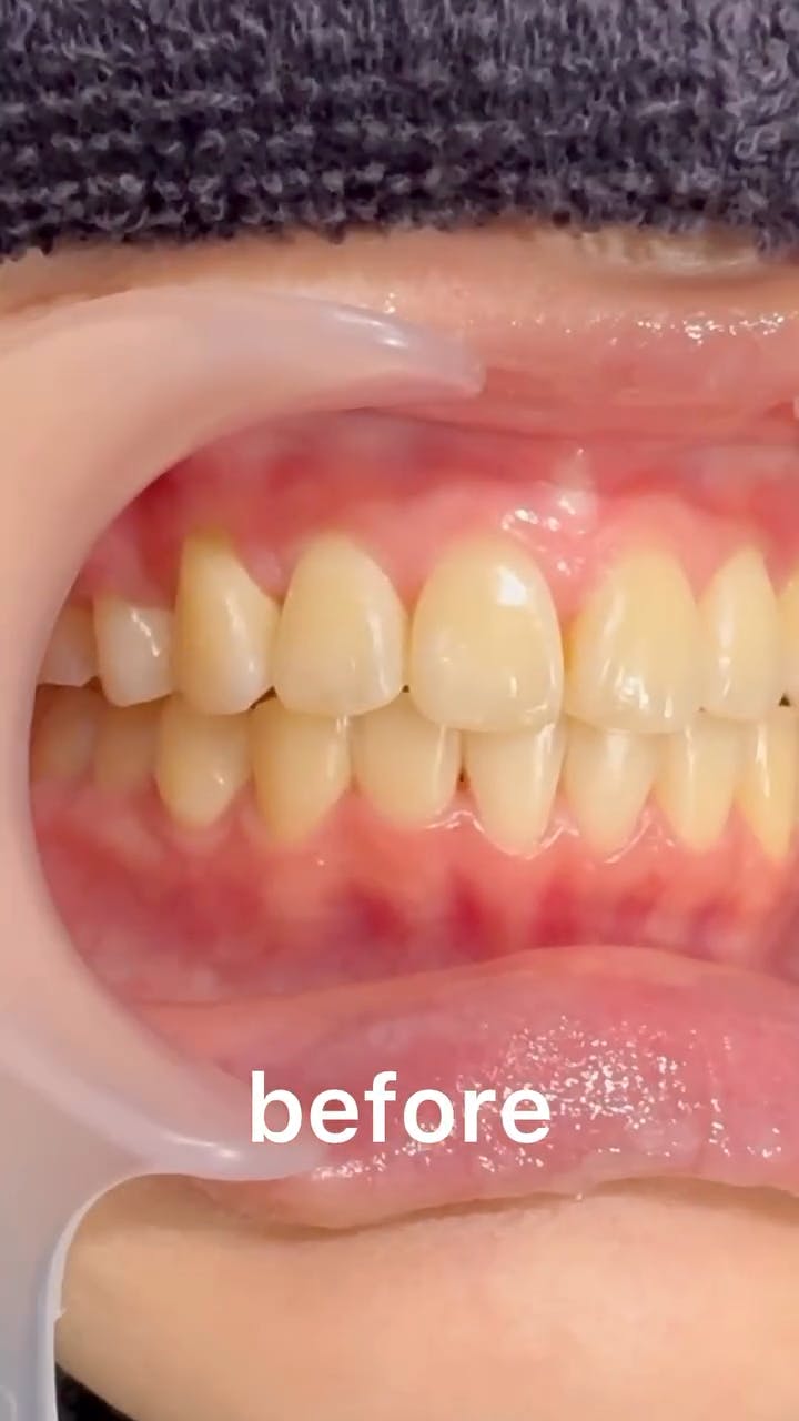 【歯】ホワイトニング_before