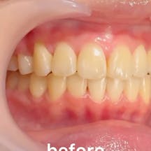 【歯】ホワイトニング_before