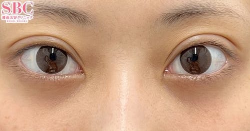 【20代女性・目元】目の下の切らないクマ・たるみ（ふくらみ）取り、ナチュラル脂肪注射コンデンスリッチ、ナチュラル脂肪注射ナノリッチ_after