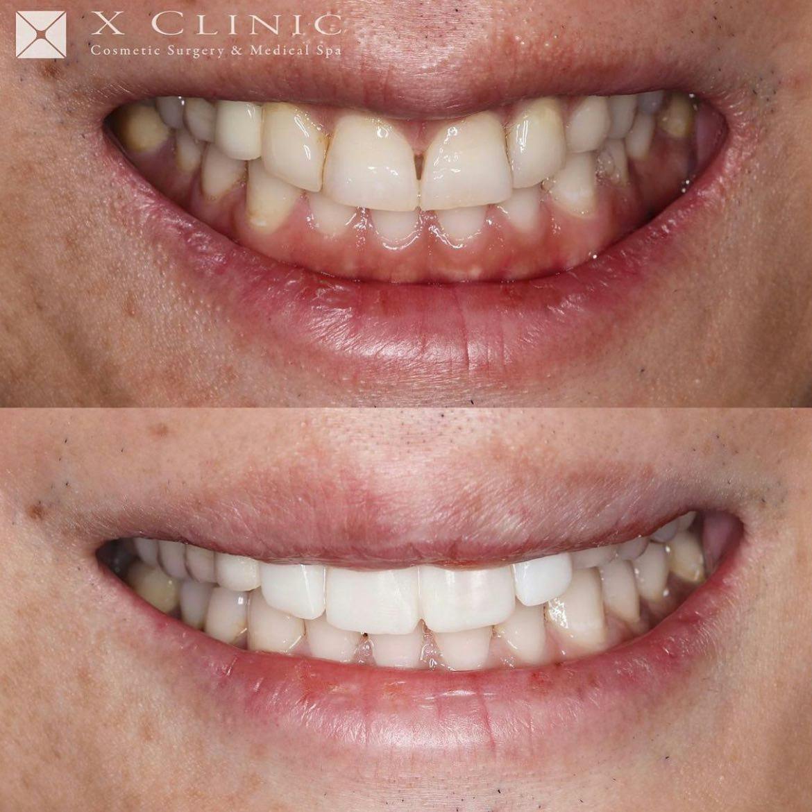 【歯】1dayスピードセラミック 矯正_before_aftar