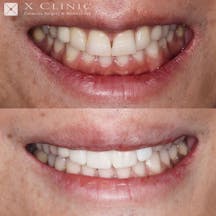 【歯】1dayスピードセラミック 矯正_before_aftar