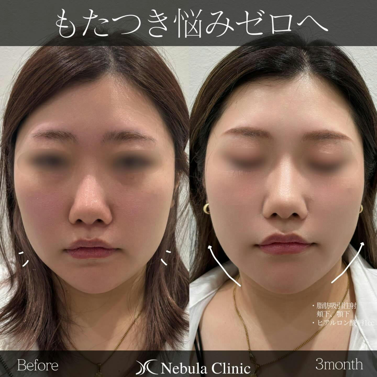 【女性・輪郭】脂肪吸引（顎下・頬下）、ヒアルロン酸_before_aftar