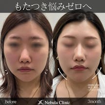 【女性・輪郭】脂肪吸引(顎下・頬下)、ヒアルロン酸_before_aftar