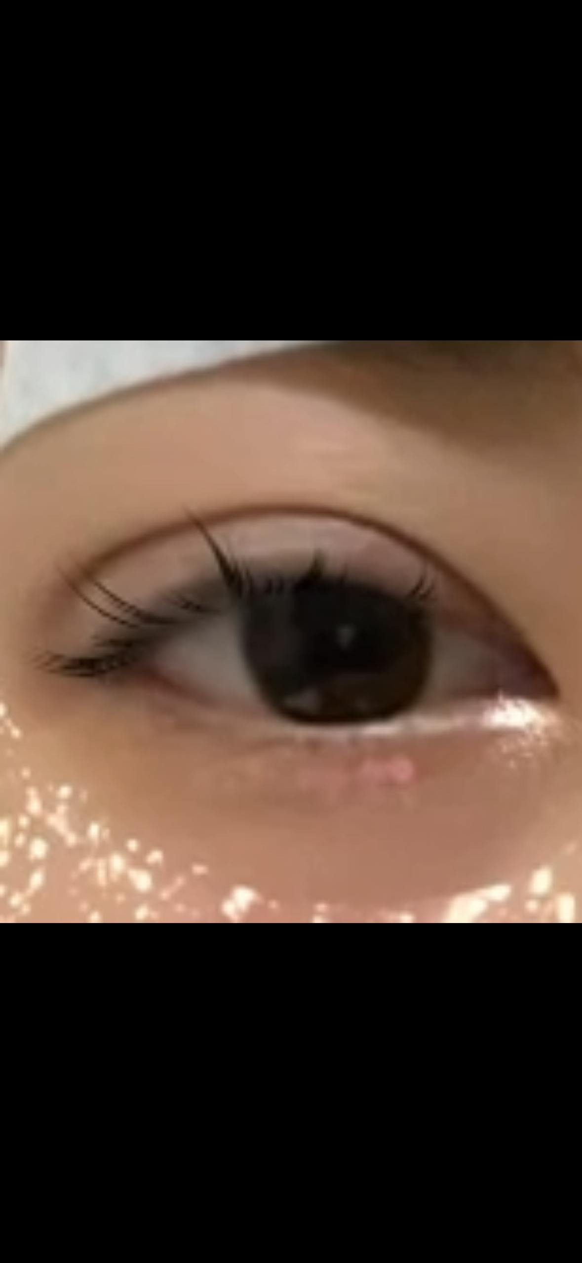 湘南美容クリニック  神戸院で二重埋没法：フォーエバー二重術を受けたあおいさんの写真