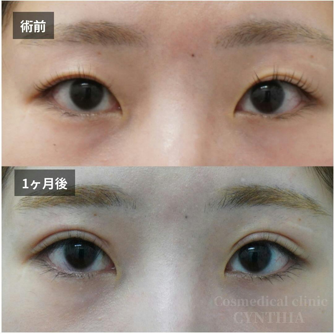 【20代女性・目元】二重埋没法_before_aftar