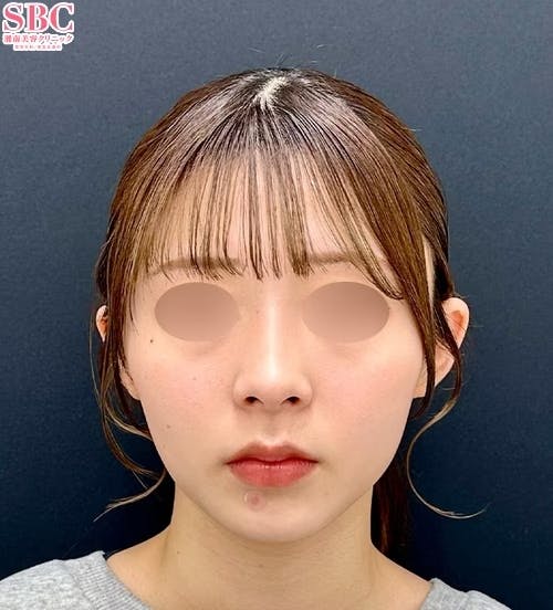 【20代女性・顔・頬】小顔用脂肪吸引注射_after