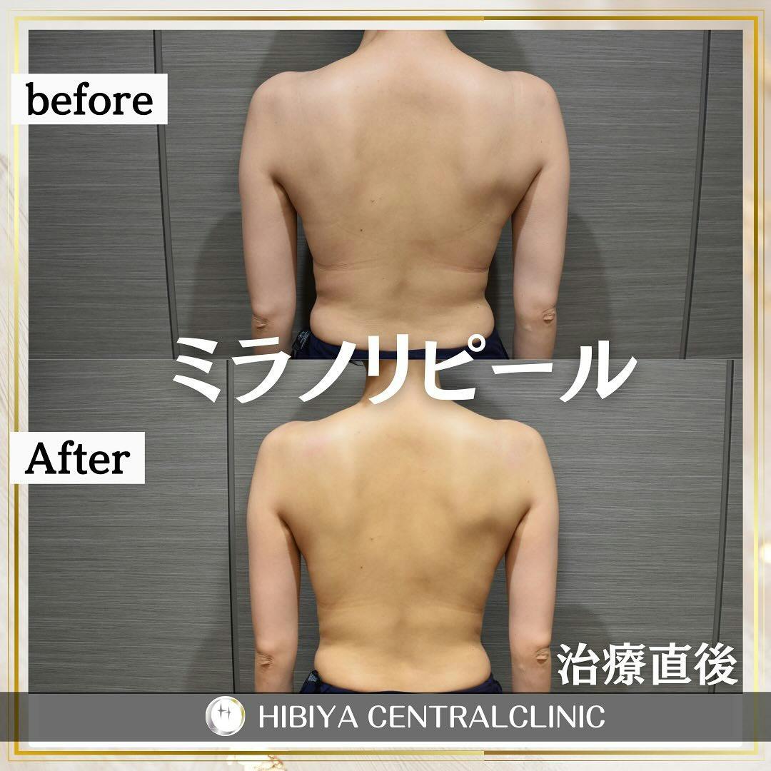 【女性・背中】ミラノリピール_before_aftar