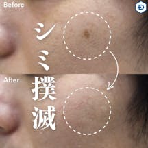 【男性・シミ】Qスイッチルビーレーザー(頬のシミ)_before_aftar