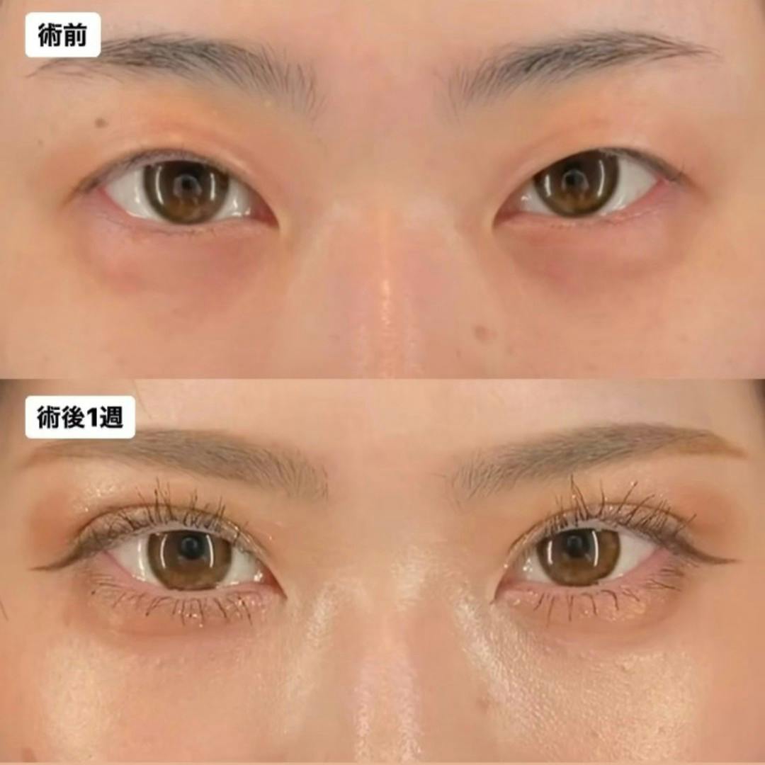 【女性・目元】Xクロストリプル_before_aftar