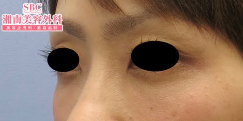 【女性・目元】目の下の切らないクマ・たるみ（ふくらみ）取り・ナチュラル脂肪注射コンデンスリッチ・ナチュラル脂肪注射_aftar