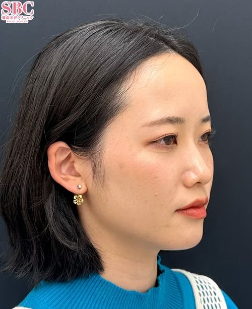 【20代女性・顔】Aquicell(アキーセル)脂肪吸引・根こそぎVASER脂肪吸引・エンブレイスRF・糸リフト_before