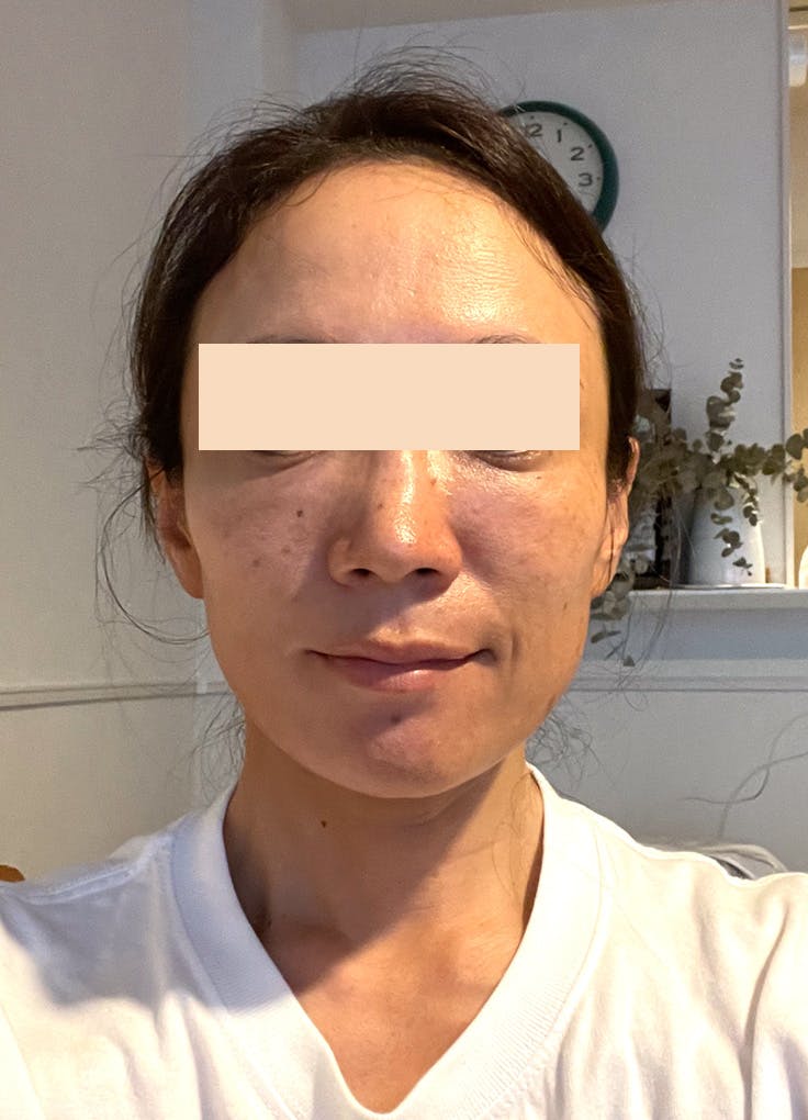 【リダイレクト済み】湘南美容クリニック 那覇院で目の下のクマ・たるみ取りを受けたappleさんの写真