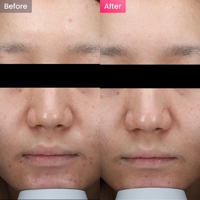 【女性・シミ】シミやくすみが気になる