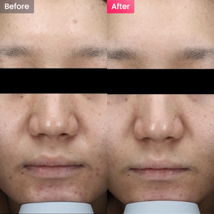 【女性・シミ】シミやくすみが気になる