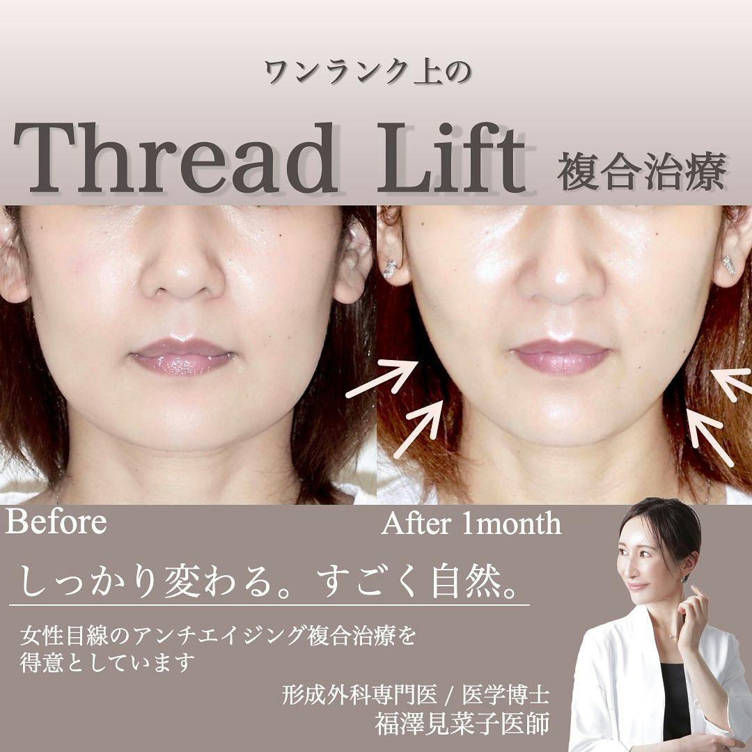【女性・輪郭】糸リフト、ボトックス_before_aftar