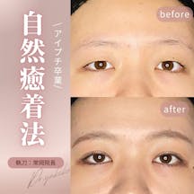 【女性・目元】自然癒着法_before_aftar