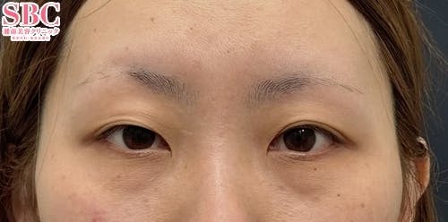 【30代女性・目元】線留めクロス二重術_before