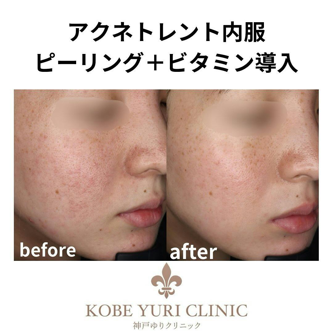 【女性・顔】アクネトレント＋ピーリング＋イオン導入_before_aftar