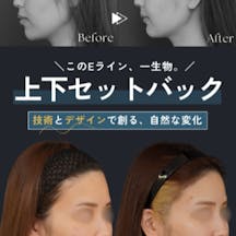 【女性・輪郭】上下セットバック+オトガイ形成_before_aftar