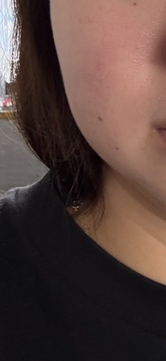 湘南美容クリニック 大阪梅田本院でボトックス注射・エラボトックス注射(小顔)・韓国製ボトックス・ボツリヌストキシン・アラガン製ボトックスを受けたnaagiiさんの写真