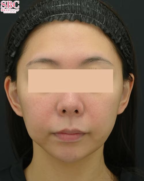 【女性・口元】切らない人中短縮_before