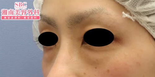 【女性・目元】目の下の切らないクマ・たるみ（ふくらみ）取り・ナチュラル脂肪注射コンデンスリッチ・ナチュラル脂肪注射_before