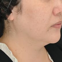 【女性・たるみ】シークレットリフト、プリマリフト、VOV(ボブ)リフト_before