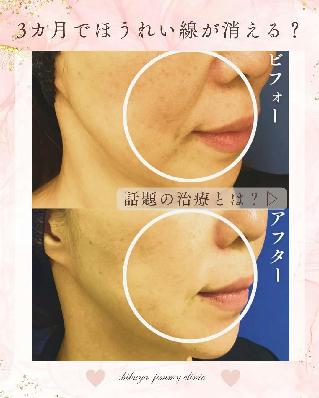 【女性・ほうれい線】プロファイロ_before_aftar