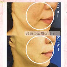 【女性・ほうれい線】プロファイロ_before_aftar