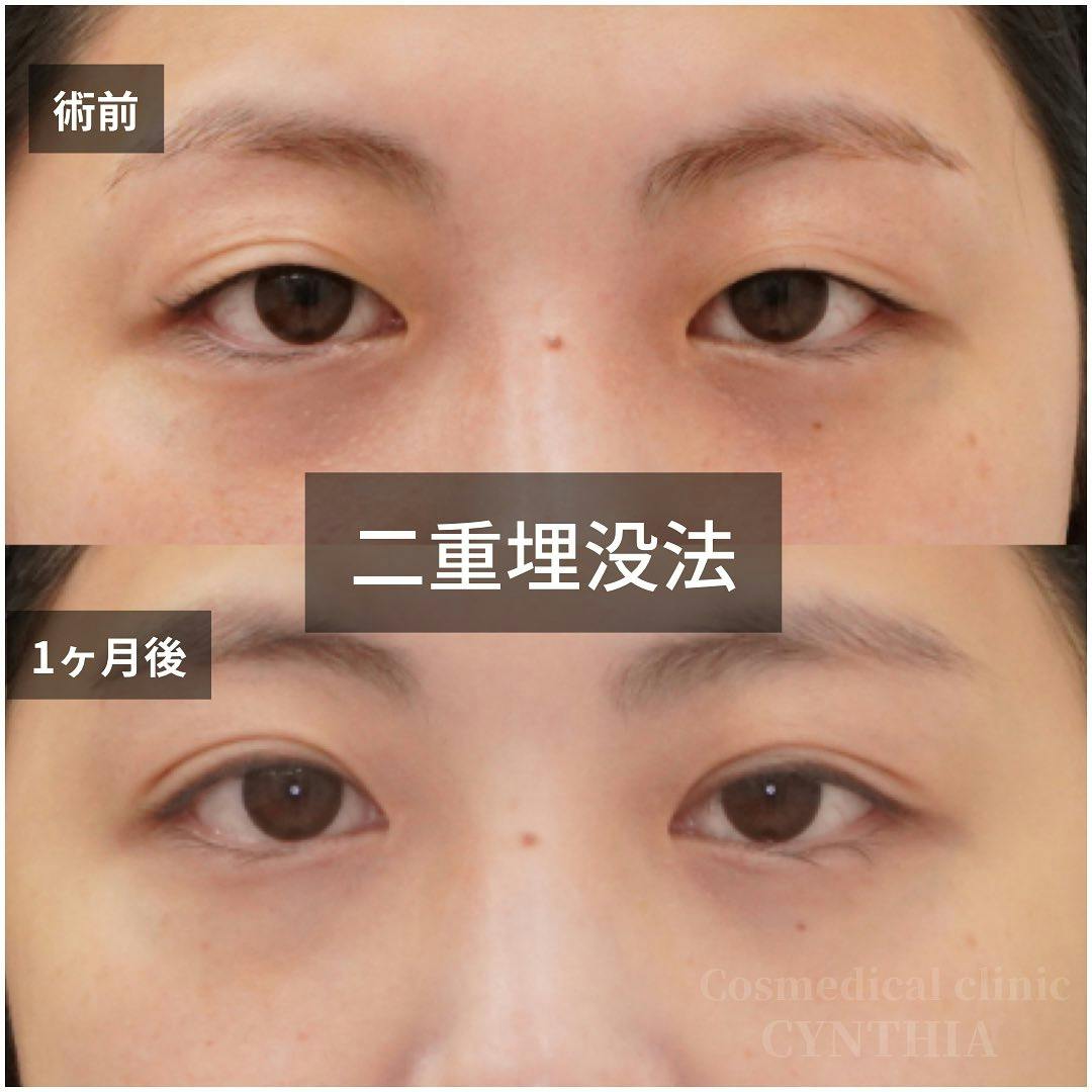 【20代女性・目元】二重埋没法_before_aftar