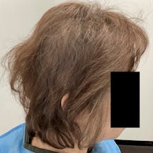 【71歳女性・頭髪】薄毛治療_after