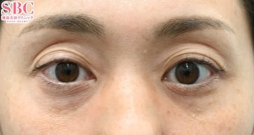 【女性・目元】裏ハムラ法、ナチュラル脂肪注射ナノリッチ_before