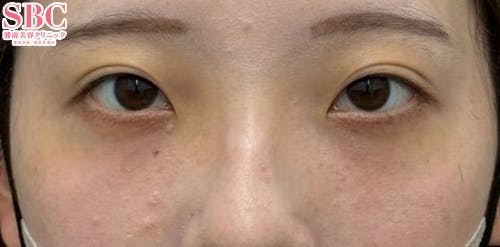 【女性・目の下】ナチュラル脂肪注射コンデンスリッチ、ナチュラル脂肪注射ナノリッチ、目の下の切らないクマ・たるみ（ふくらみ）取り_aftar