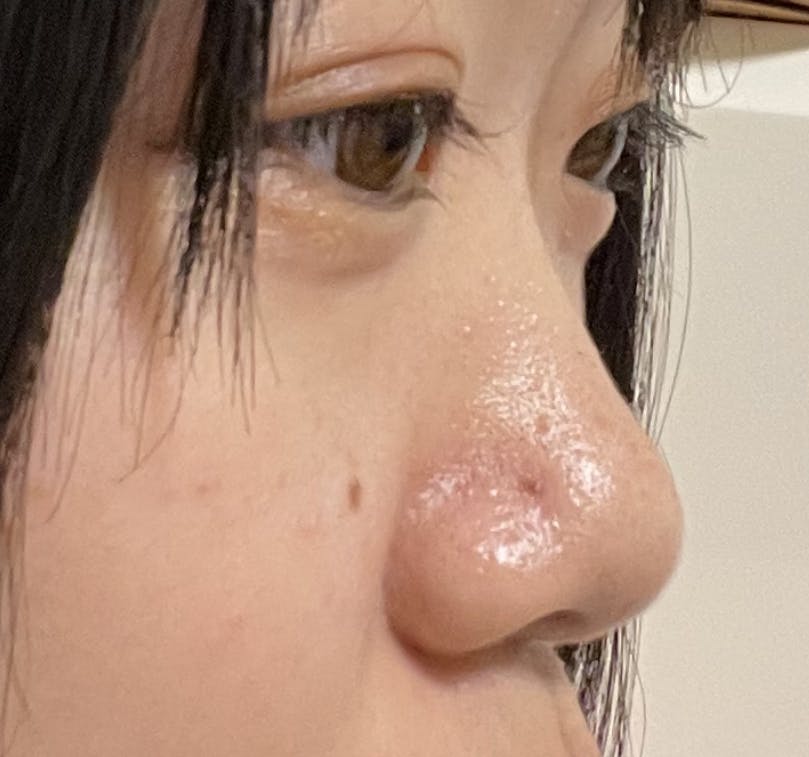CZEN CLINIC 銀座院で鼻のヒアルロン酸注入モニターを受けたゆなちゃんさんの写真