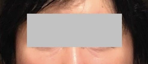 エールクリニック(AILE Clinic)で目の下のクマ・たるみ取り・目元整形・経結膜脱脂法を受けたカイさんの写真