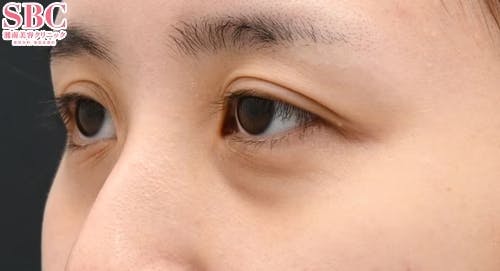 【20代女性・目元】目の下の切らないクマ・たるみ（ふくらみ）取り、ナチュラル脂肪注射コンデンスリッチ、ナチュラル脂肪注射ナノリッチ_before