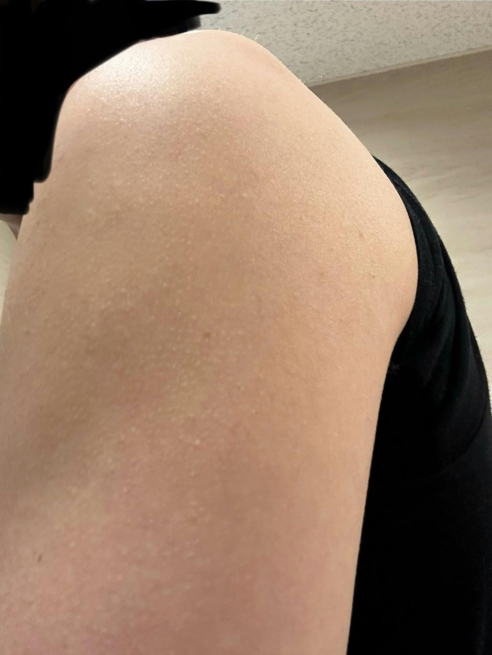 赤坂クリニックで針脱毛を受けたNTさんの写真