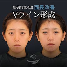 【20代女性・輪郭】Vライン形成(エラ+オトガイ)、外板除去_before_aftar
