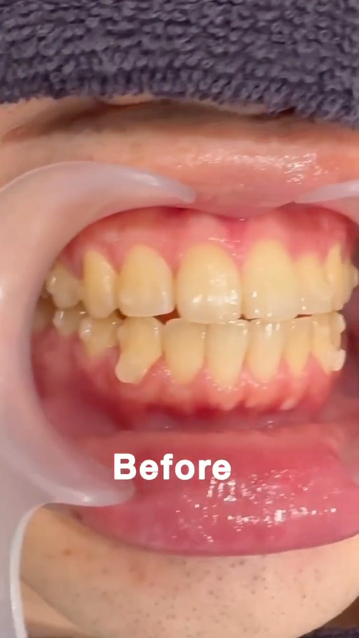 【男性・歯】アートメイク_before